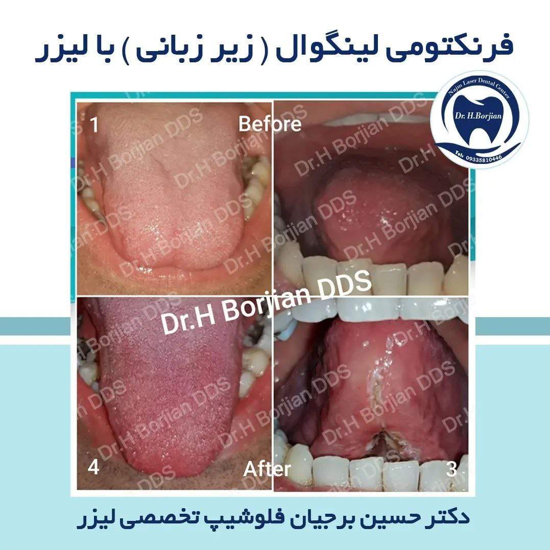 درمان فرنکتومی لینگوال ( زیر زبانی ) با لیزر