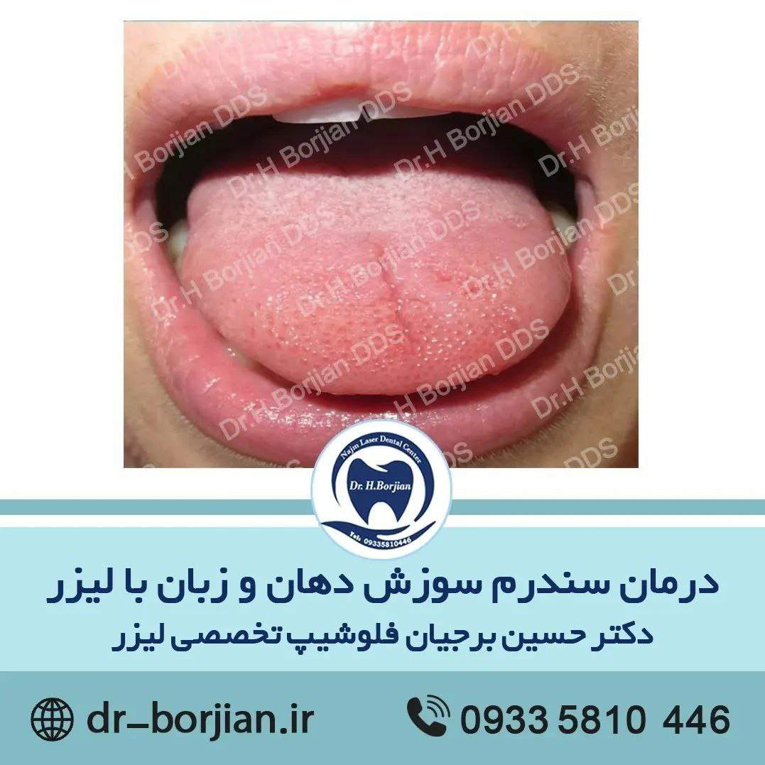 درمان سندرم سوزش دهان و زبان با لیزر