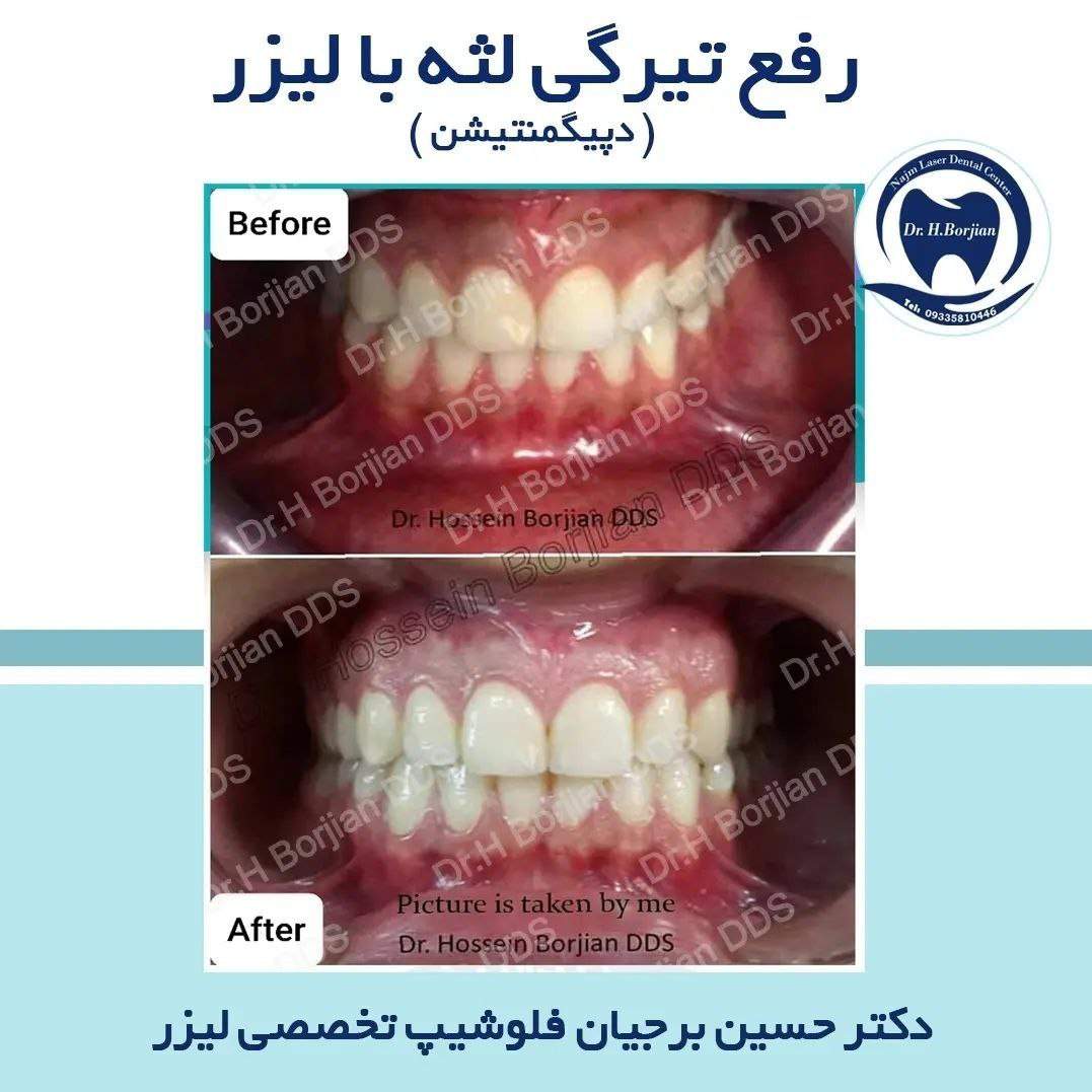 رفع تیرگی لثه با لیزر توسط دکتر حسین برجیان