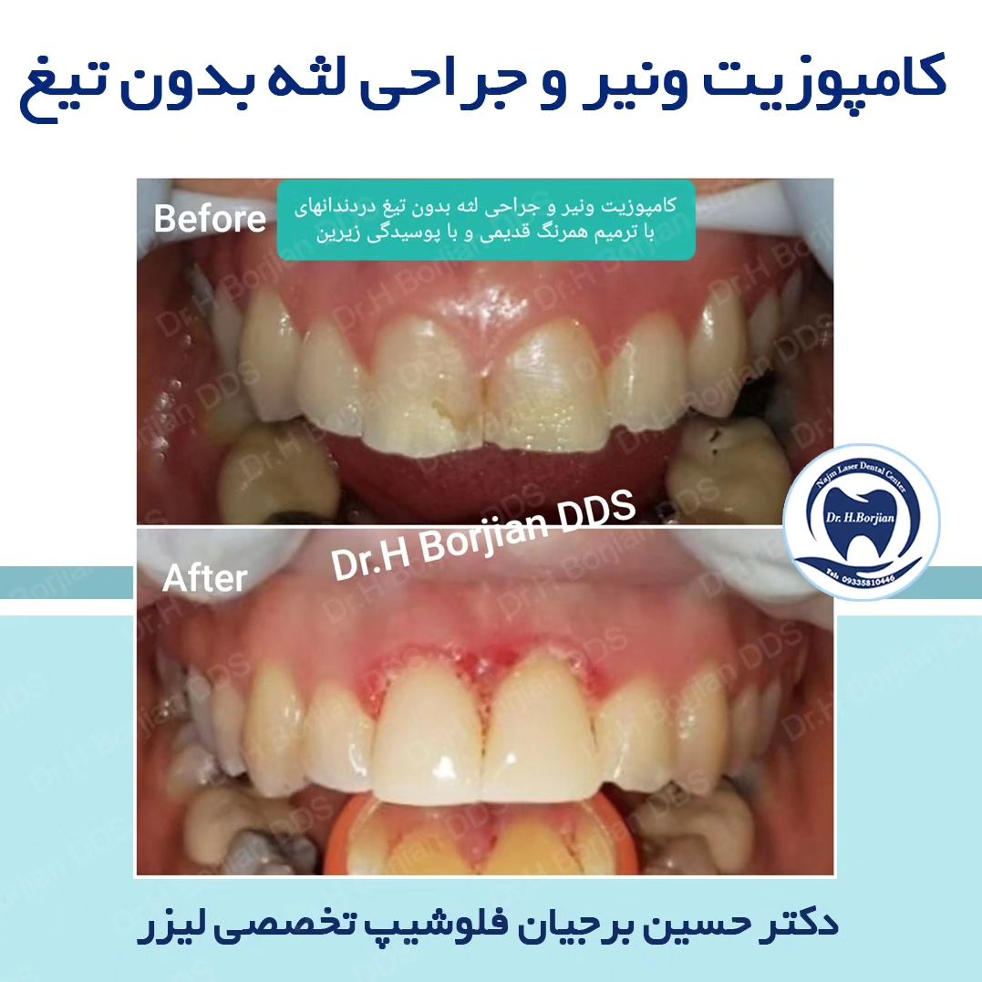 درمان کامپوزیت ونیر زیبایی همزمان با جراحی لثه