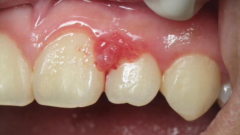 روش‌های پیشگیری از بیماری‌های لثه