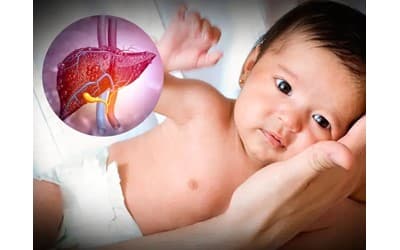 بیماری‌های کبدی در کودکان: هپاتیت ویروسی، اتوایمیون و متابولیک در اصفهان