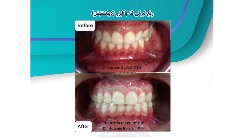 نمونه عمل رفع تیرگی لثه با لیزر (دپیگمنتیشن)