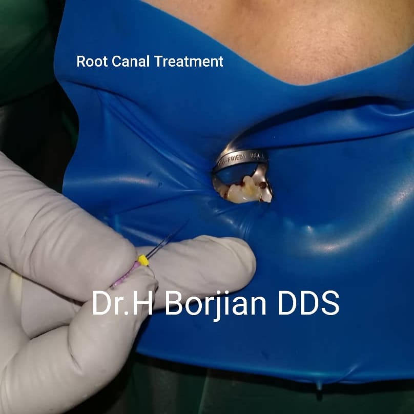 درمان ریشه (عصب کشی) مولر ۴ کاناله فک پایین، با استفاده از رابر دم