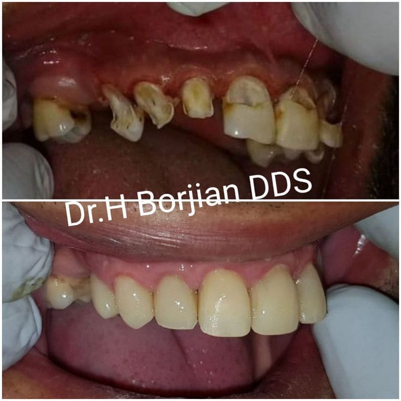 درمان جامع شامل کامپوزیت بیلد آپ و کامپوزیت ونیر زیبایی