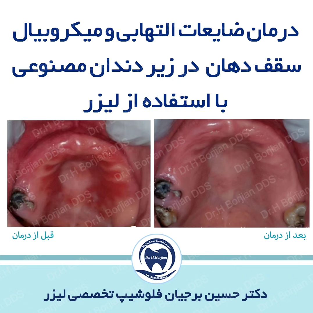 درمان ضایعات التهابی و میکروبی سقف دهان