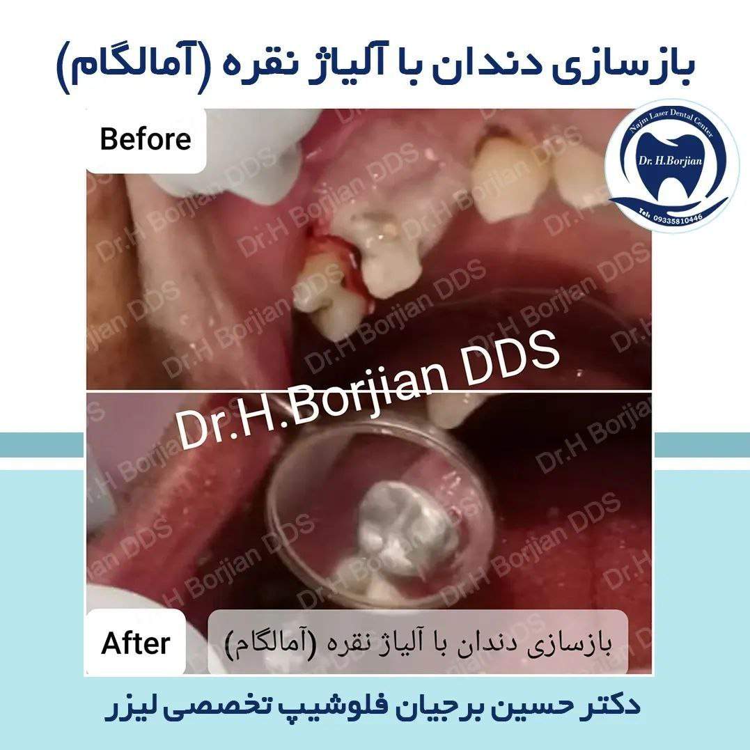 بازسازی دندان با آلیاژ نقره