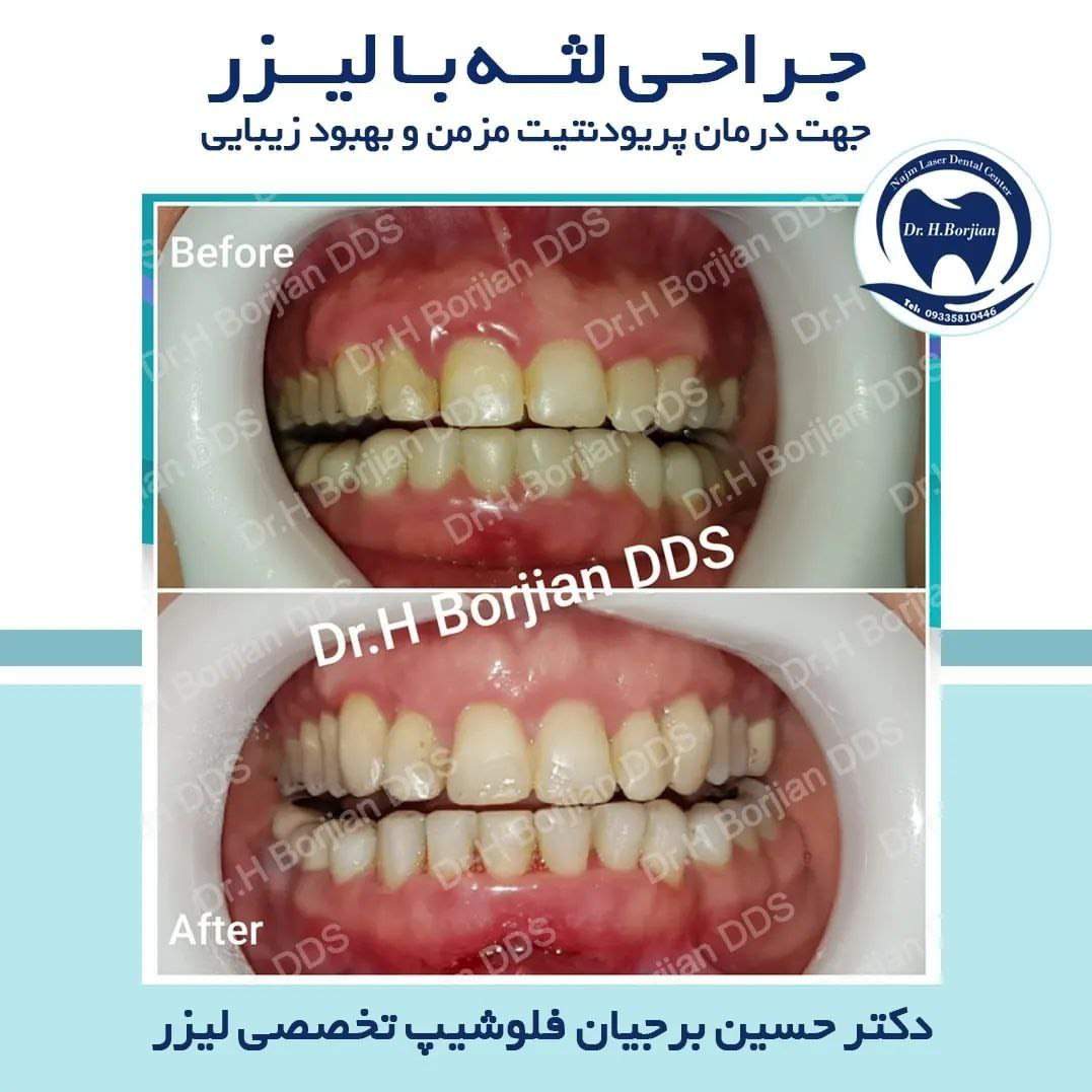 جـراحـی لثــه بـا لیــزر جهت درمان پریودنتیت مزمن و بهبود زیبایی