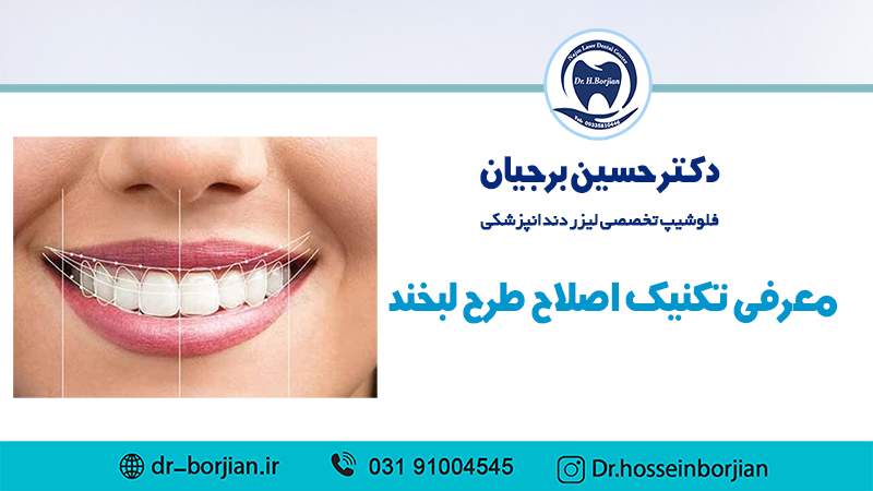 معرفی تکنیک اصلاح طرح لبخند توسط بهترین دندانپزشک اصفهان