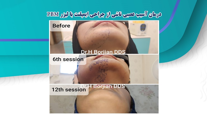 درمان آسیب عصبی ناشی از جراحی ایمپلنت با لیزر PBM