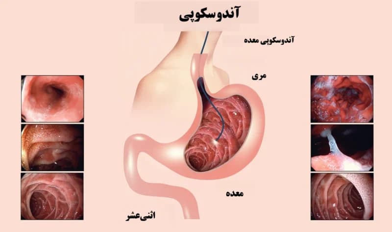 اندوسکوپی تشخیصی در مشکلات گوارشی: از زخم معده تا حساسیتهای غذایی کودکان اصفهان