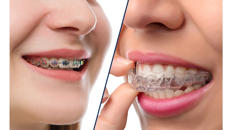 ارتودنسی نامرئی یا براکت سنتی؟